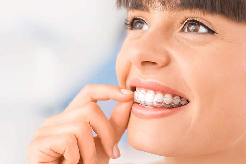 Invisalign Express in Beverly Hills