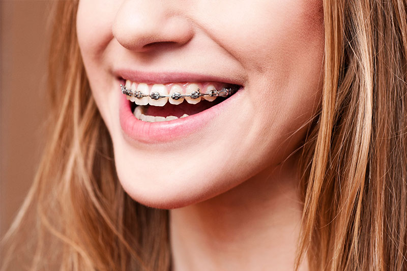Traditional Braces in Beverly Hills